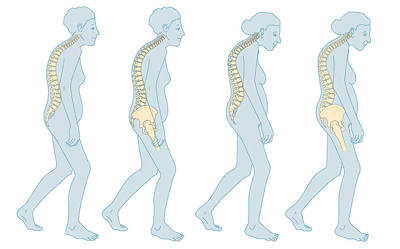 Osteoporosis ~ image by Osteoporosis Laboratoires Servier / CC BY-SA (https://creativecommons.org/licenses/by-sa/3.0)