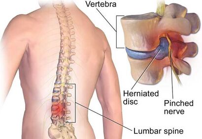 Herniated disc ~ Blausen.com staff (2014). "Medical gallery of Blausen Medical 2014". WikiJournal of Medicine 1 (2). DOI:10.15347/wjm/2014.010. ISSN 2002-4436. / CC BY (https://creativecommons.org/licenses/by/3.0)wikicommons